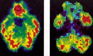 Scans of a normal brain, left, beside that of murderer Antonio Bustamante, who was spared the death penalty after a jury was shown these pictures.